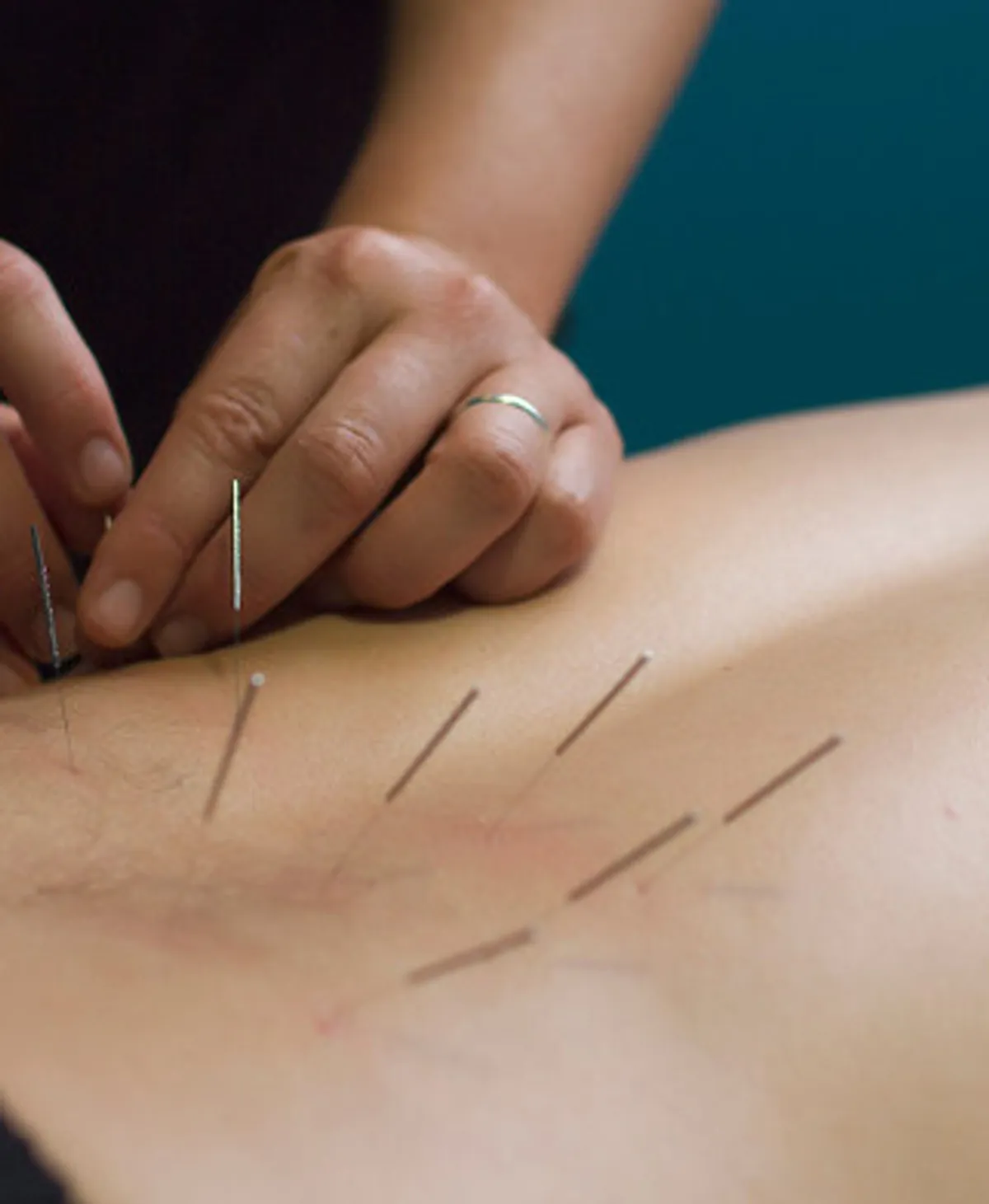 Dry needling treatment